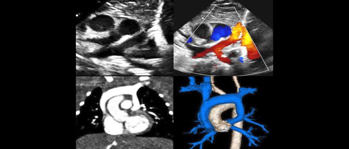 Annual Morphology and Imaging in Congenital Heart Disease: The Key to Diagnosis and Management at San Antonio Marriott Riverwalk